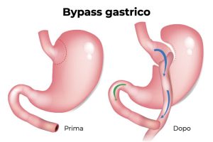 Scopri di più sull'articolo Bypass Gastrico